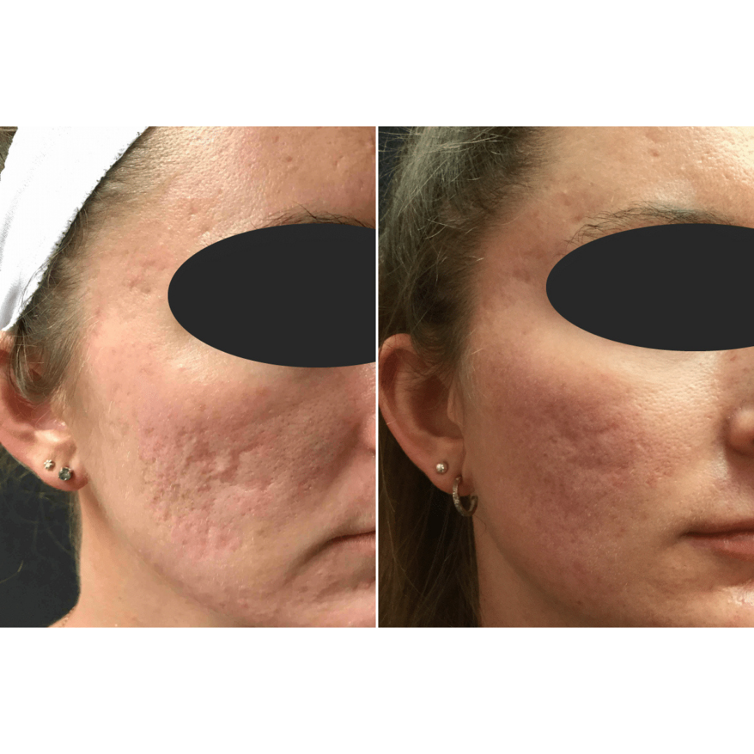 ScarFade Silicone Scar Stick