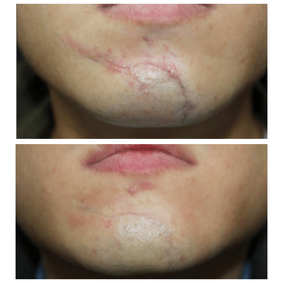 ScarFade Silicone Scar Stick