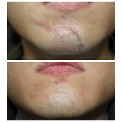 ScarFade Silicone Scar Stick