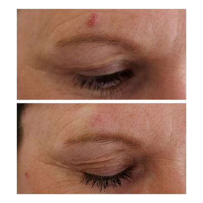 ScarFade Silicone Scar Stick