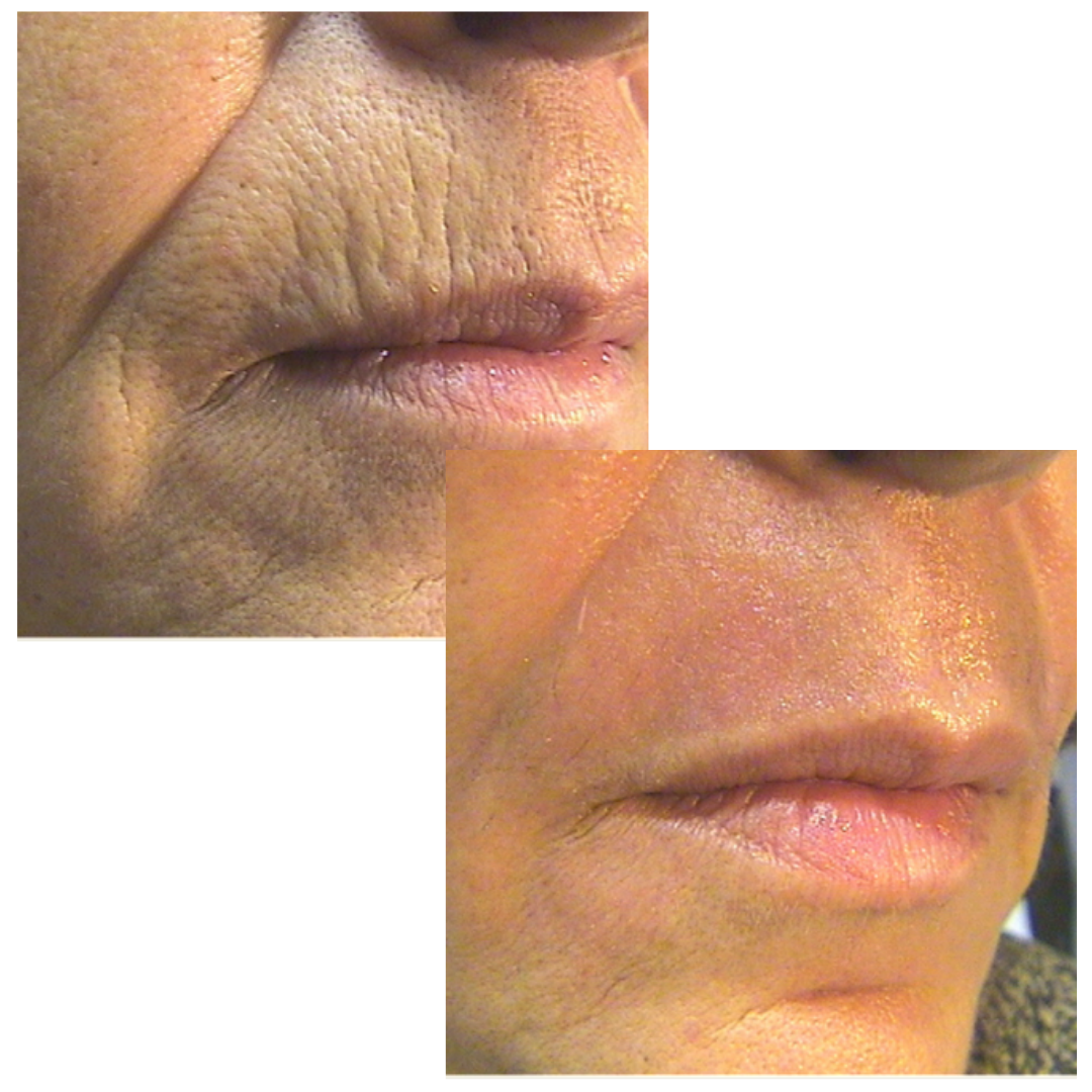 ScarFade Silicone Scar Stick